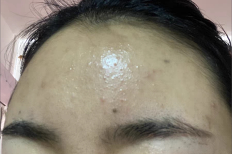 黑素细胞痣前额斑图