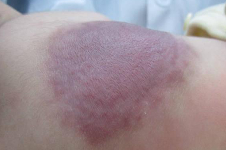 新生儿海绵状血管瘤图 新生儿海绵状血管瘤图