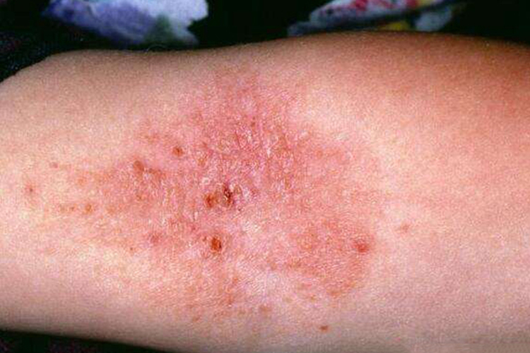 手肘内窝亚急性湿疹图 手肘内窝亚急性湿疹图