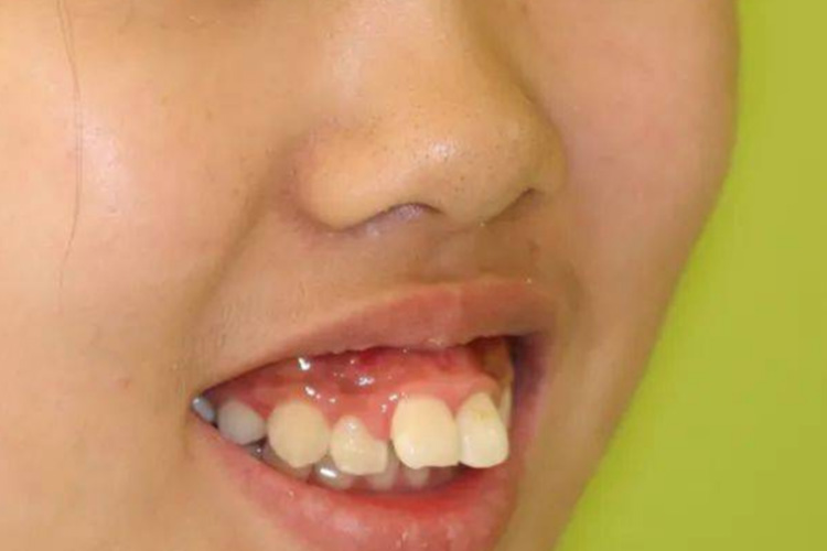 龅牙齿微笑露齿龈图 龅牙齿微笑露齿龈图