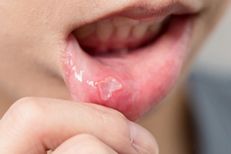 瘢痕性类天疱疮唇内侧凹陷图 瘢痕性类天疱疮唇内侧凹陷图