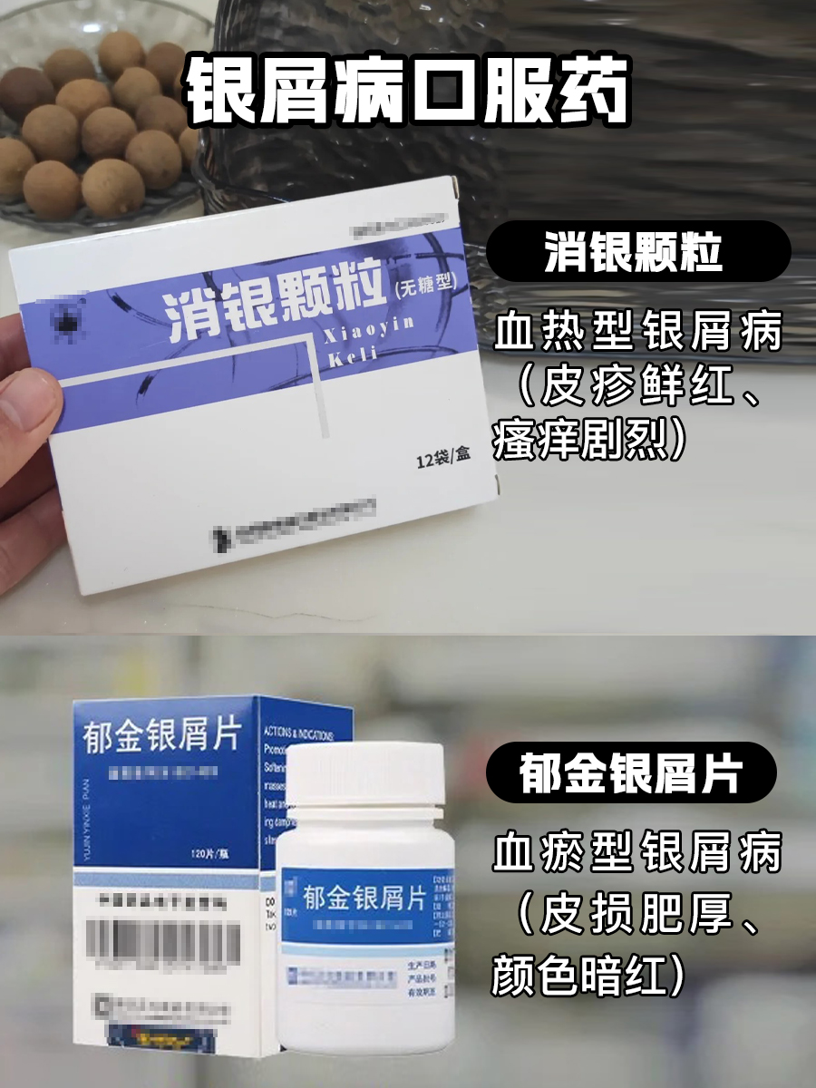 银屑病口服药-医生手把手教你对抗银屑病！