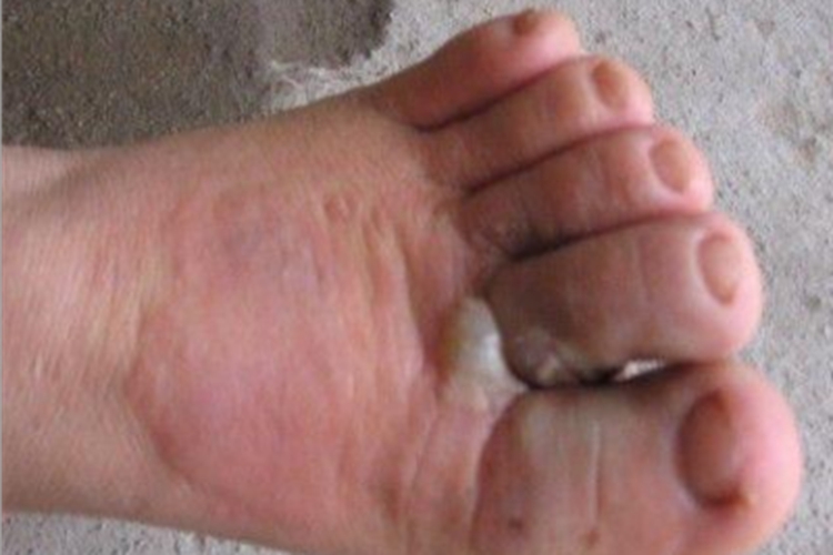 疱疹型癣菌疹脚背水疱图