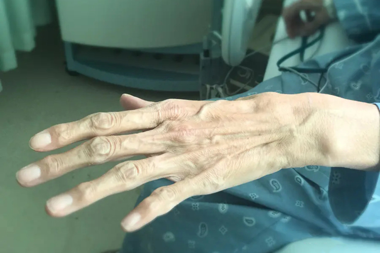 马凡氏综合征手指图