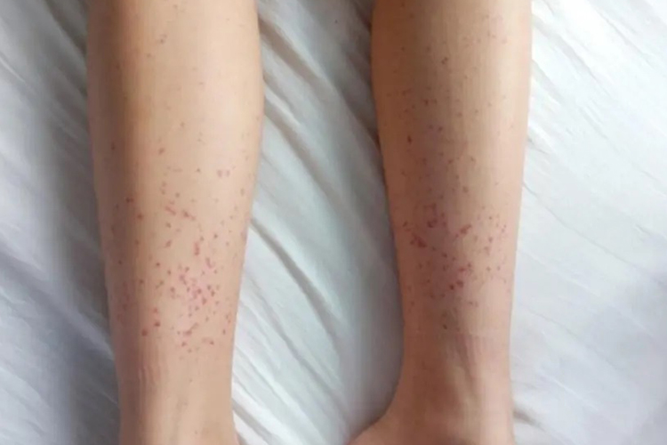 轻微血小板减少性紫癜初期图