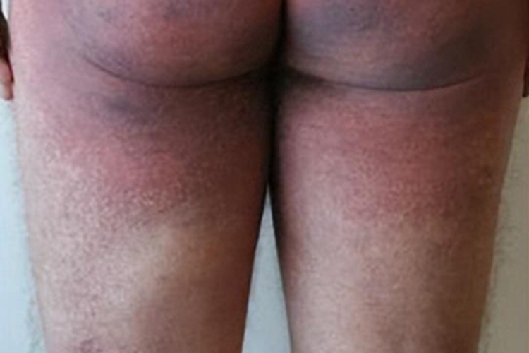 炎症后色素沉着臀部有深色斑块图