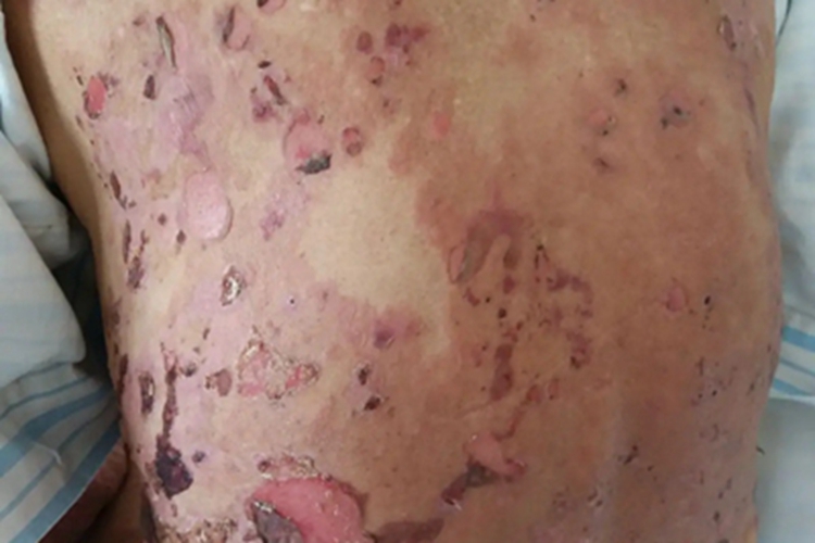 疱疹样天疱疮背部红斑图 疱疹样天疱疮背部红斑图