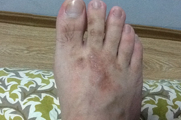 鳞屑角化型足癣皮肤颜色加深图 鳞屑角化型足癣皮肤颜色加深图
