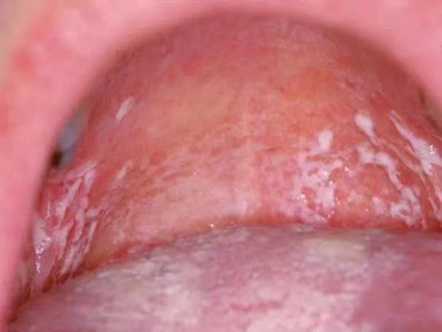 新生儿鹅口疮上腭有白色斑膜图.jpg
