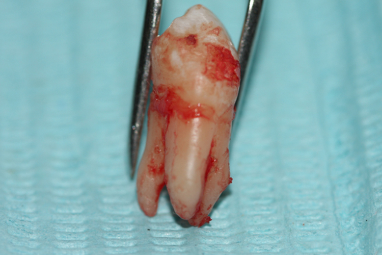 左上第一磨牙牙根图