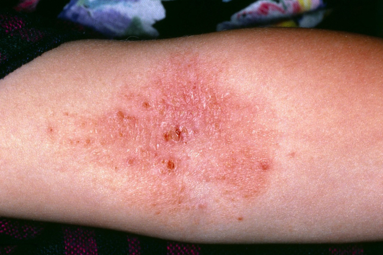 吃鸽子肉过敏皮肤糜烂图