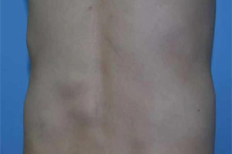 血管脂肪瘤包块图