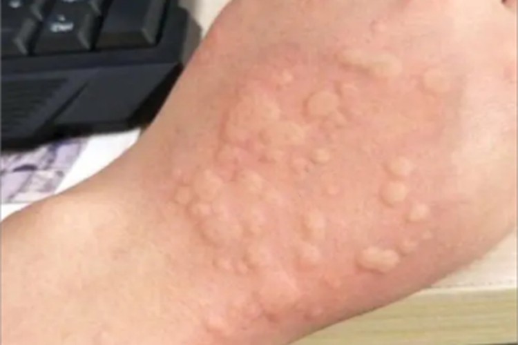 荨麻疹手背红斑图