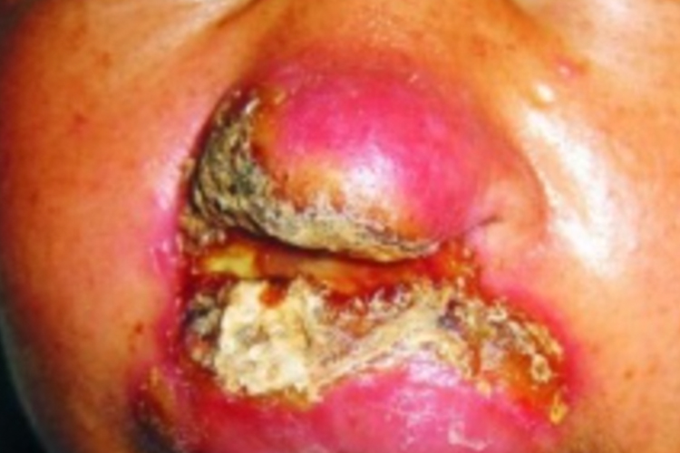 鼻淋巴瘤鼻外部坏死图