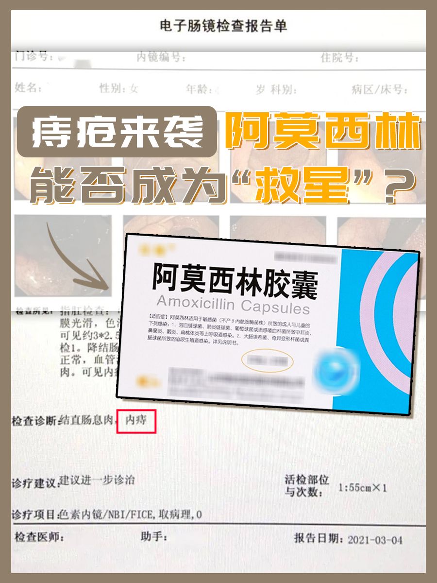 痔疮来袭，阿莫西林能否成为“救星”？