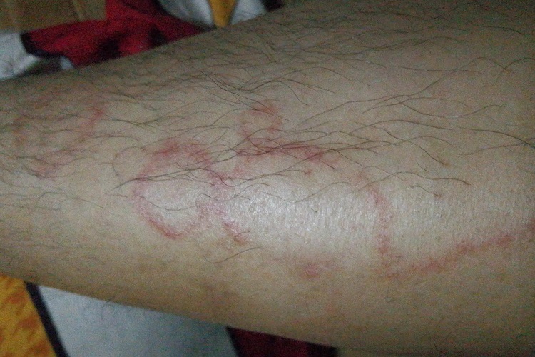 匐行性回状红斑小腿症状图