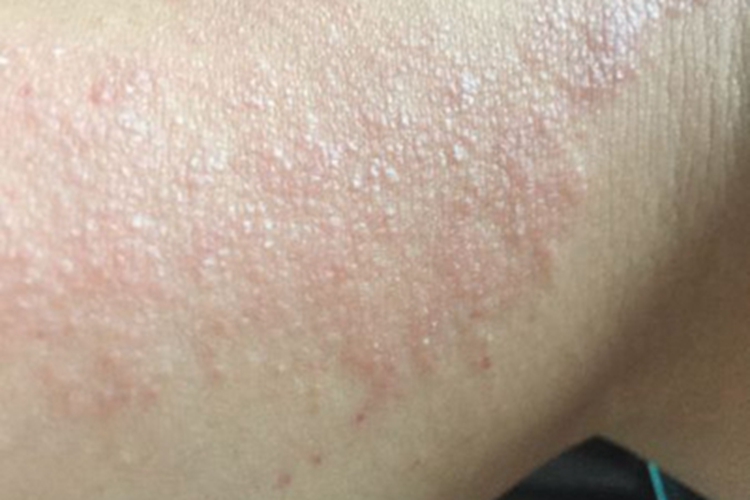 日照性皮炎大腿红斑图