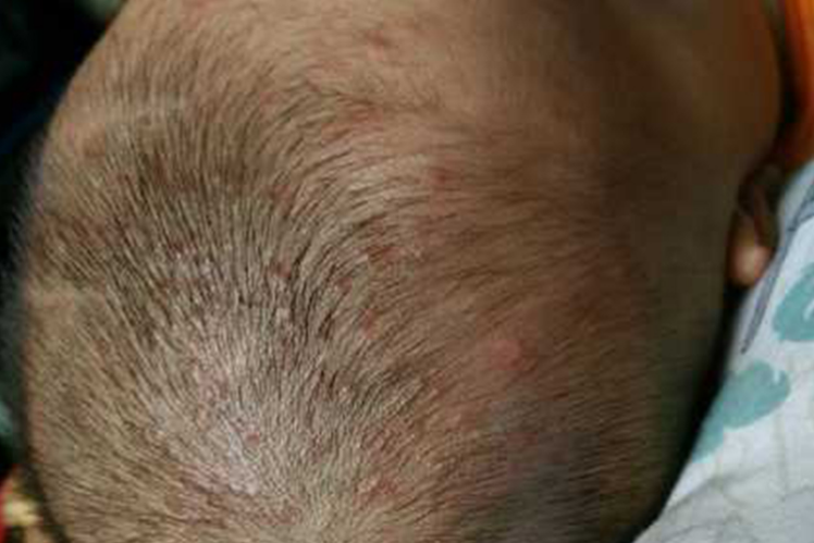 儿童头部毛囊炎图 儿童头部毛囊炎图