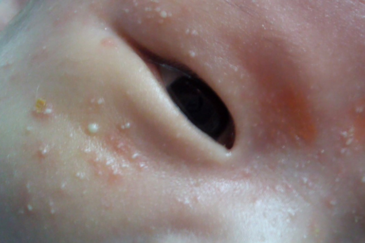 婴儿深痱图 婴儿深痱图