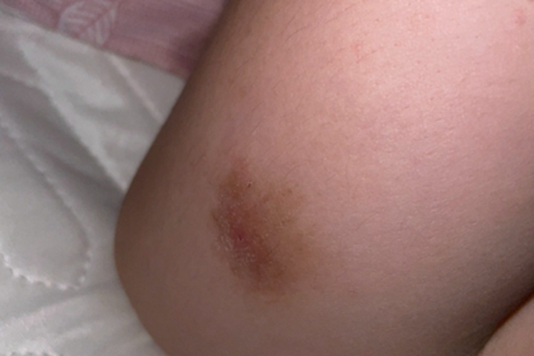 亚急性湿疹大腿脱屑图 亚急性湿疹大腿脱屑图