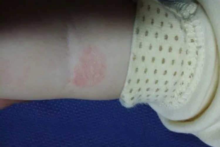 宝宝体癣图 宝宝体癣图