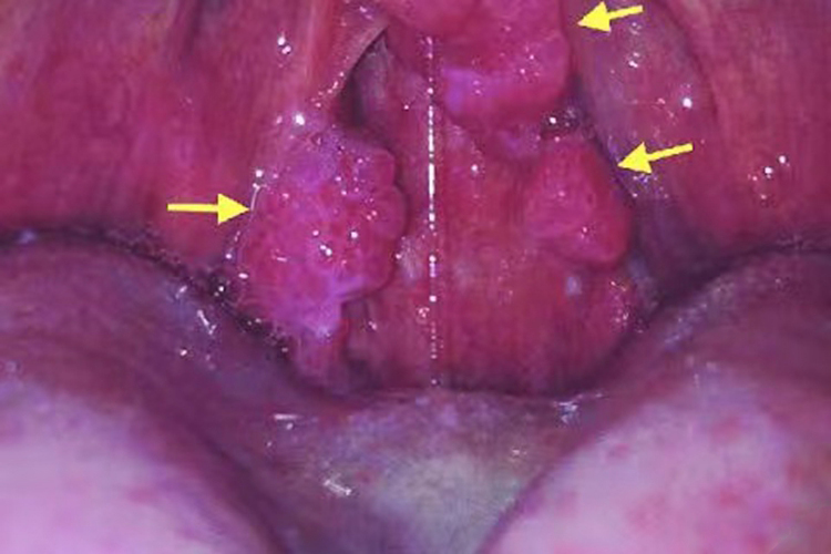 咽部尖锐湿疣图 咽部尖锐湿疣图