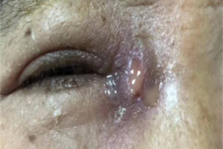 慢性泪囊炎眼角症状图