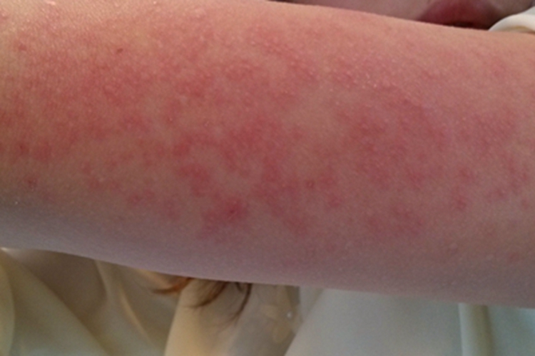 高IgD综合征胳膊上有丘疹图