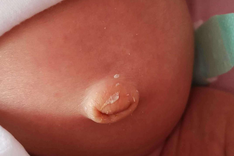 脐带脱落创面愈合图