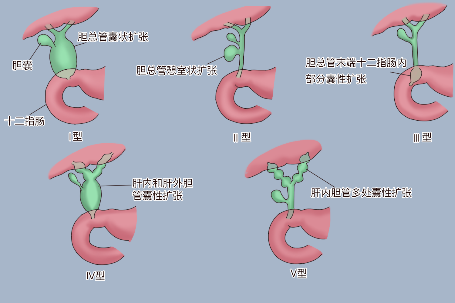 胆管囊肿分型图