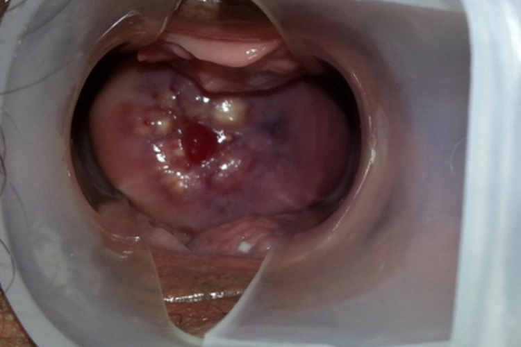 纳氏囊肿图 纳氏囊肿图