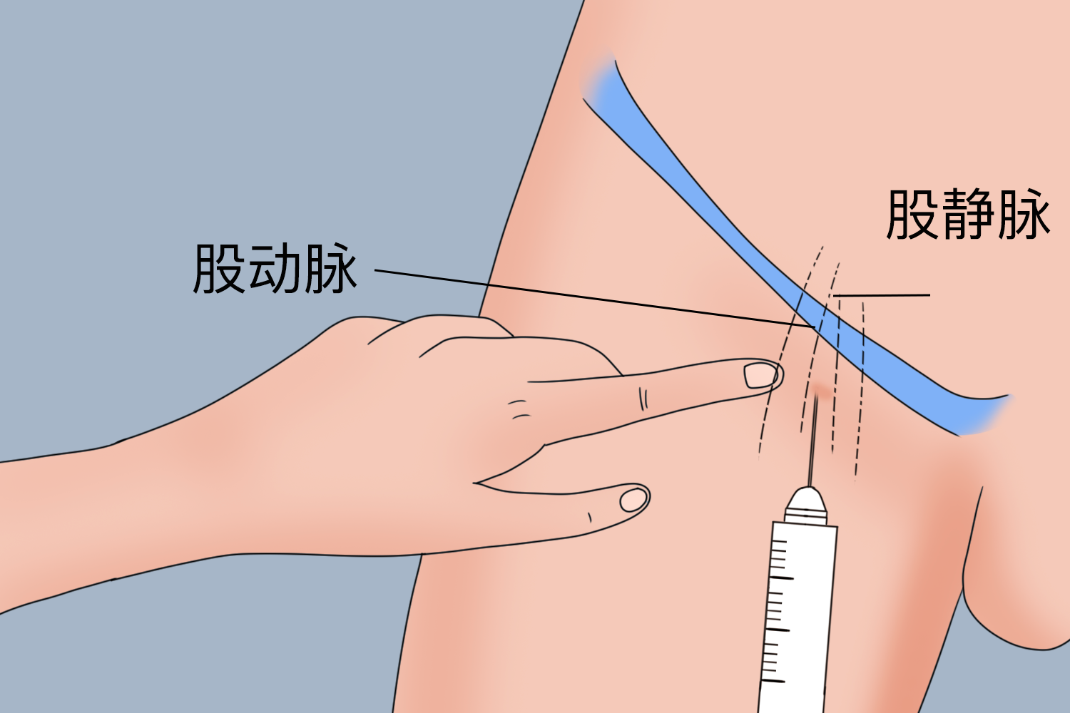 新生儿动脉抽血定位图图片