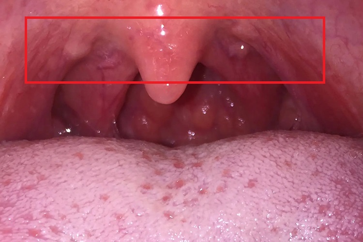 急性咽炎腭咽弓白色凸起图 急性咽炎腭咽弓白色凸起图