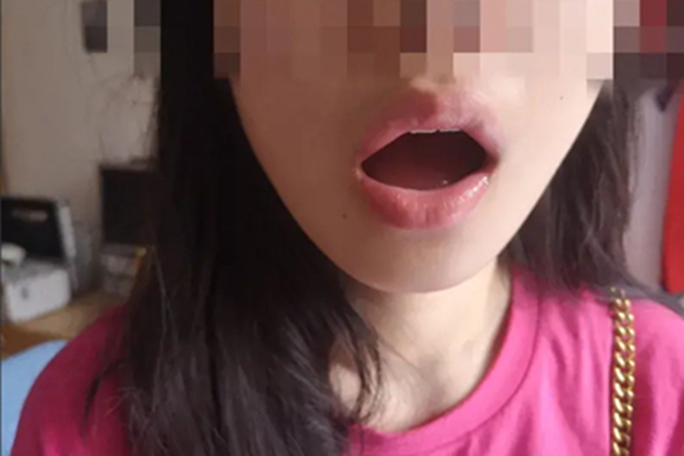 小口畸形嘴巴张不大图