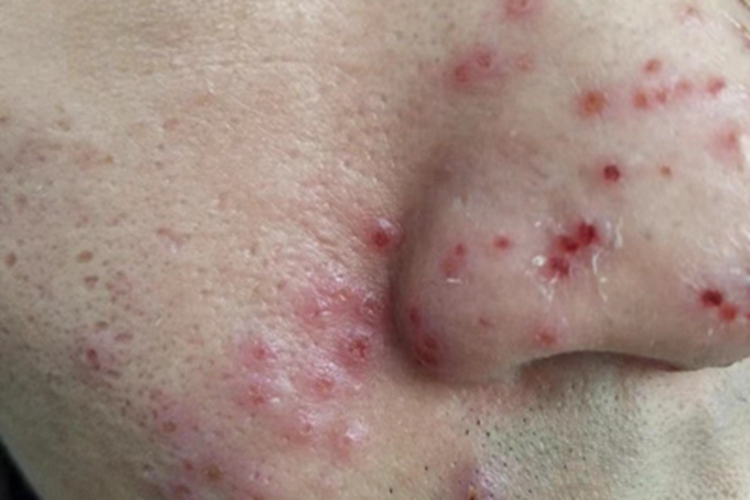 疱疹样湿疹面部丘疹图 疱疹样湿疹面部丘疹图