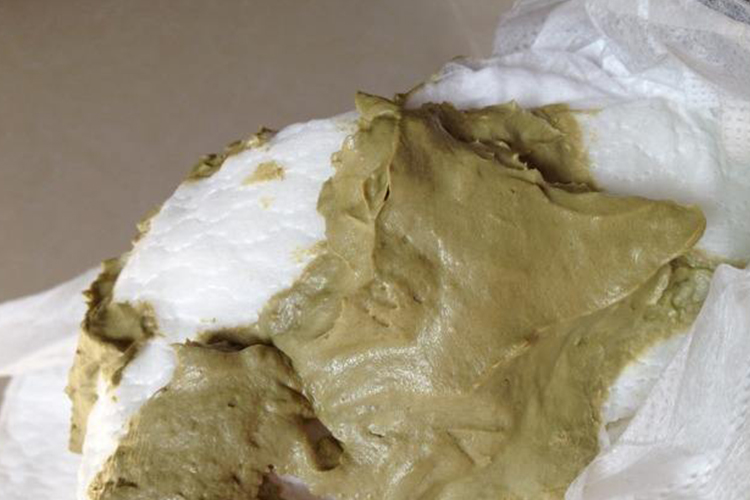 宝宝胆道阻塞导致拉白陶土色便图 宝宝胆道阻塞导致拉白陶土色便图