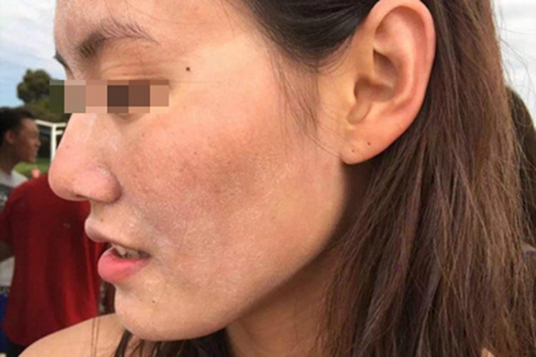 日光性皮炎面部症状图 日光性皮炎面部症状图