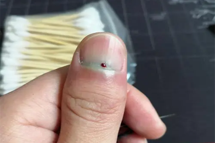 甲外伤指甲根部鼓包图