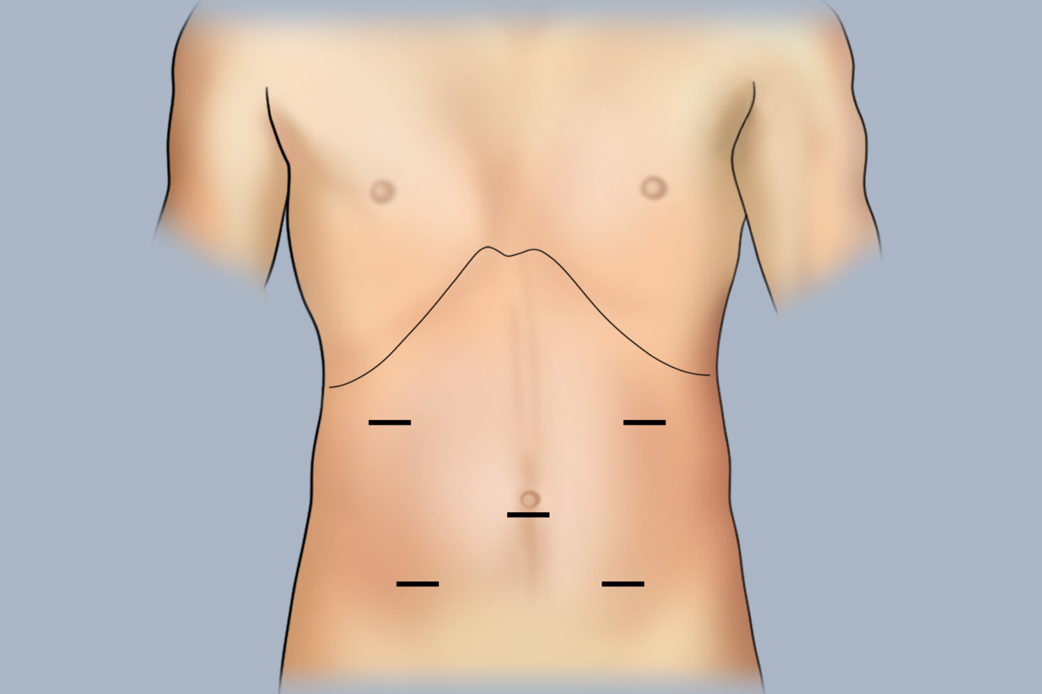 左半结肠癌的打孔位置图