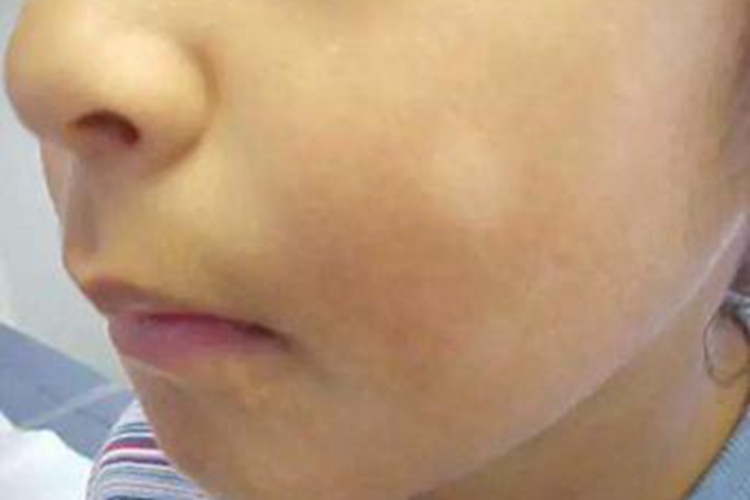 白色糠疹图 白色糠疹图