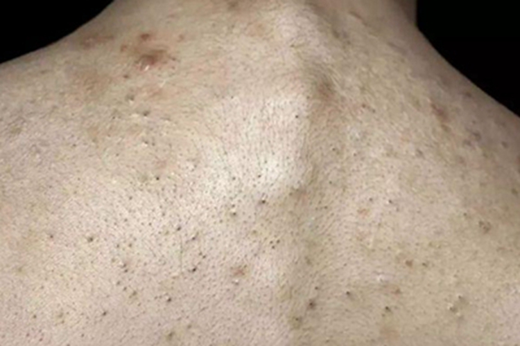 黑头粉刺痣背部症状图 黑头粉刺痣背部症状图