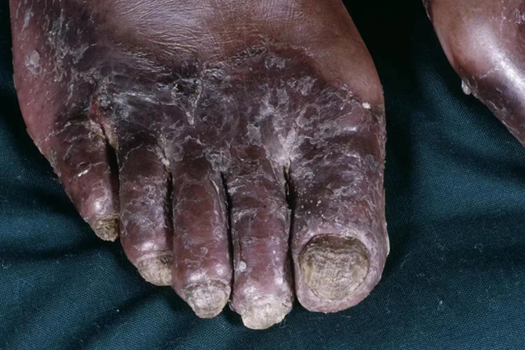 艾滋病脚趾溃烂图