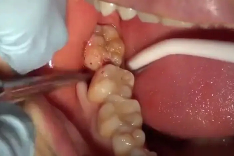 右侧下颌智齿完全萌出图