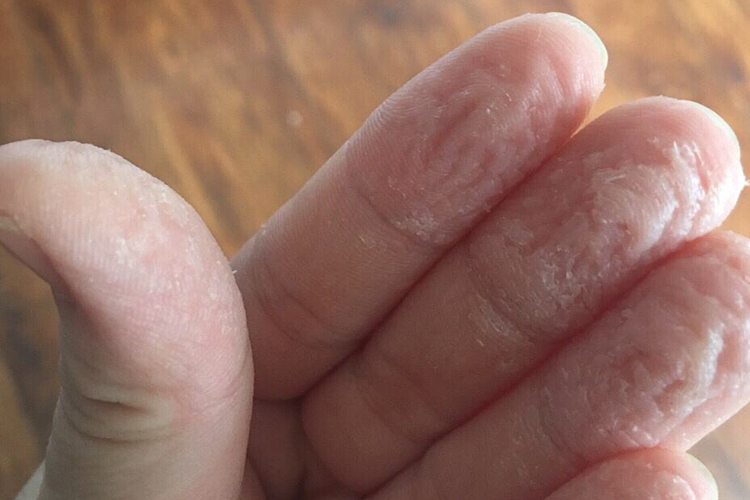 手部浸渍性皮炎图