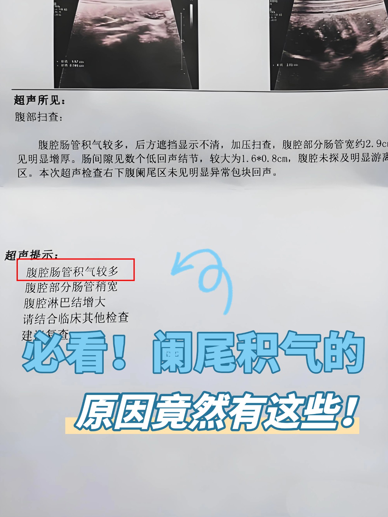 必看！阑尾积气的原因竟然有这些！