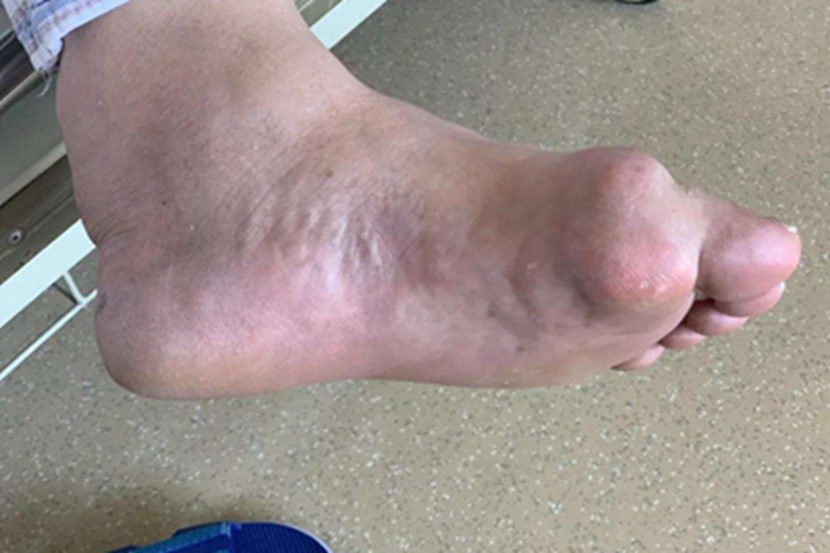 Ⅱ型痛性肥胖病大包图 Ⅱ型痛性肥胖病大包图