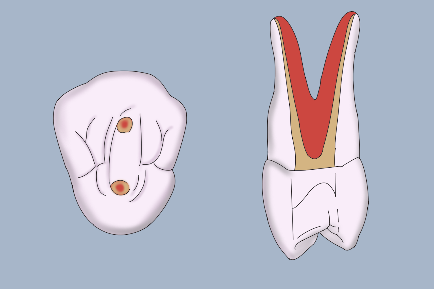 乳牙开髓位置3d图图片
