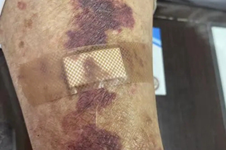 异常蛋白血症紫癜胳膊紫斑图