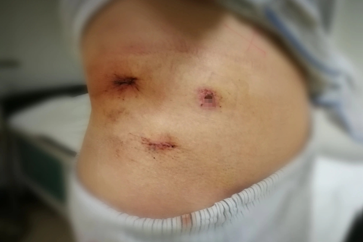 腹腔镜肾囊肿打孔位置图