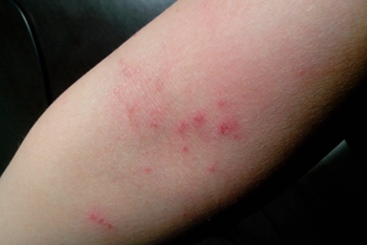 淋巴瘤样丘疹病皮肤颜色加深图 淋巴瘤样丘疹病皮肤颜色加深图